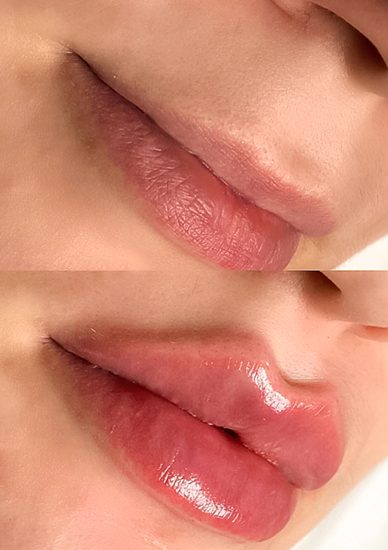 Синяки и отеки после увеличения губ: заживление | Блог клиники Медиэстетик